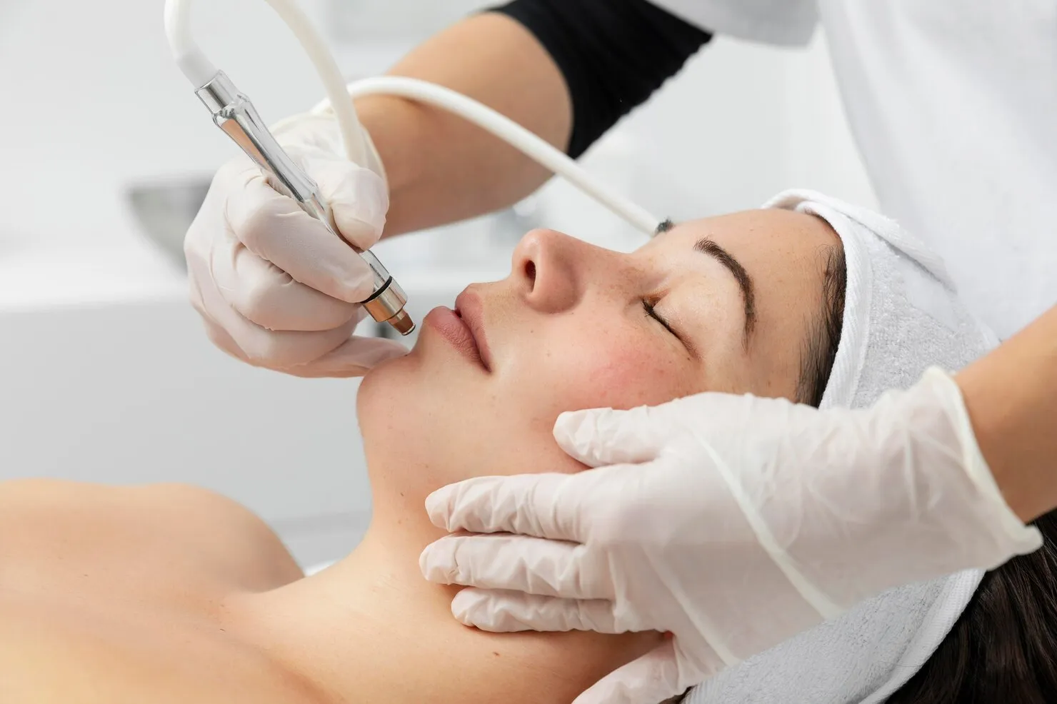 Milifrac microneedling illustration